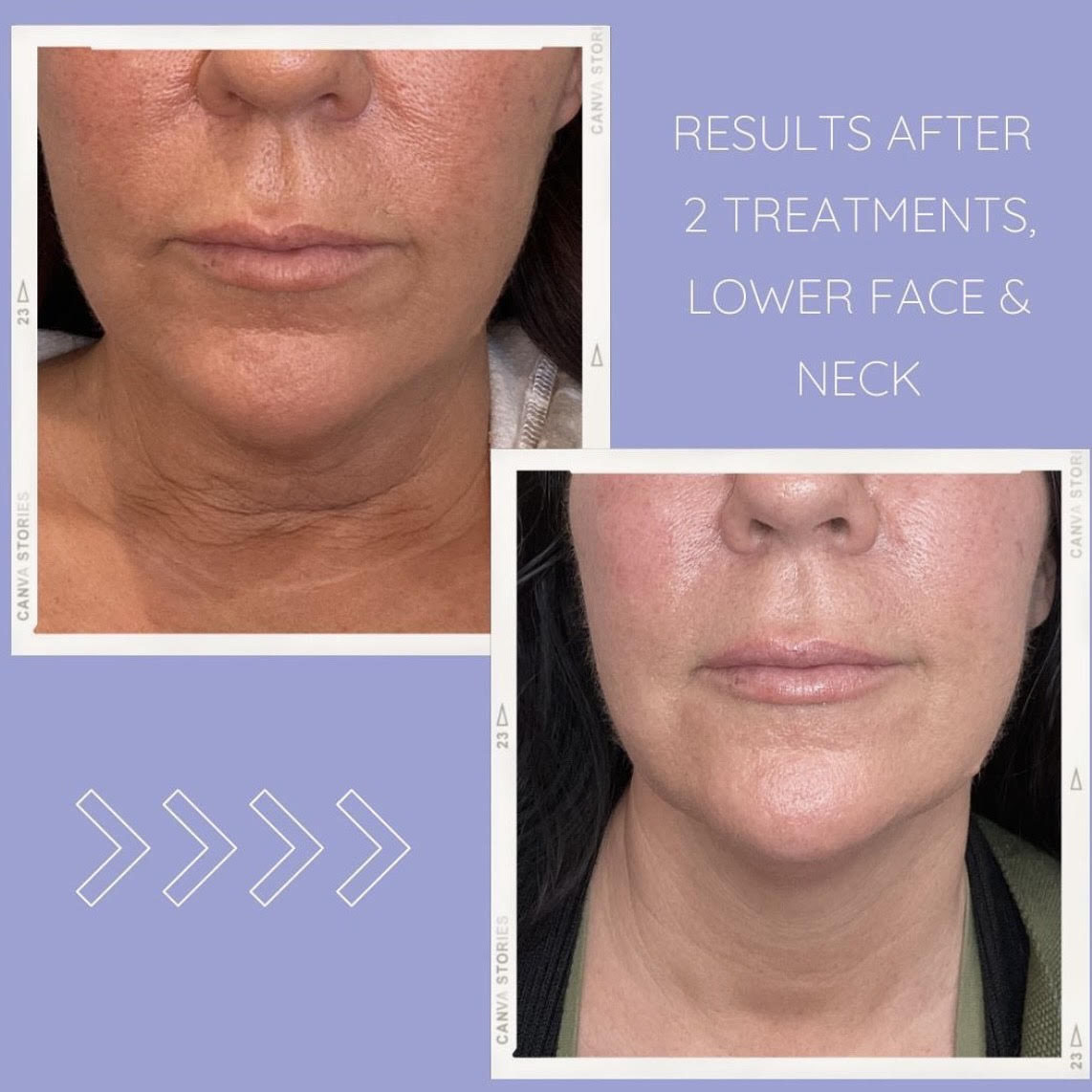 11s before and after botox