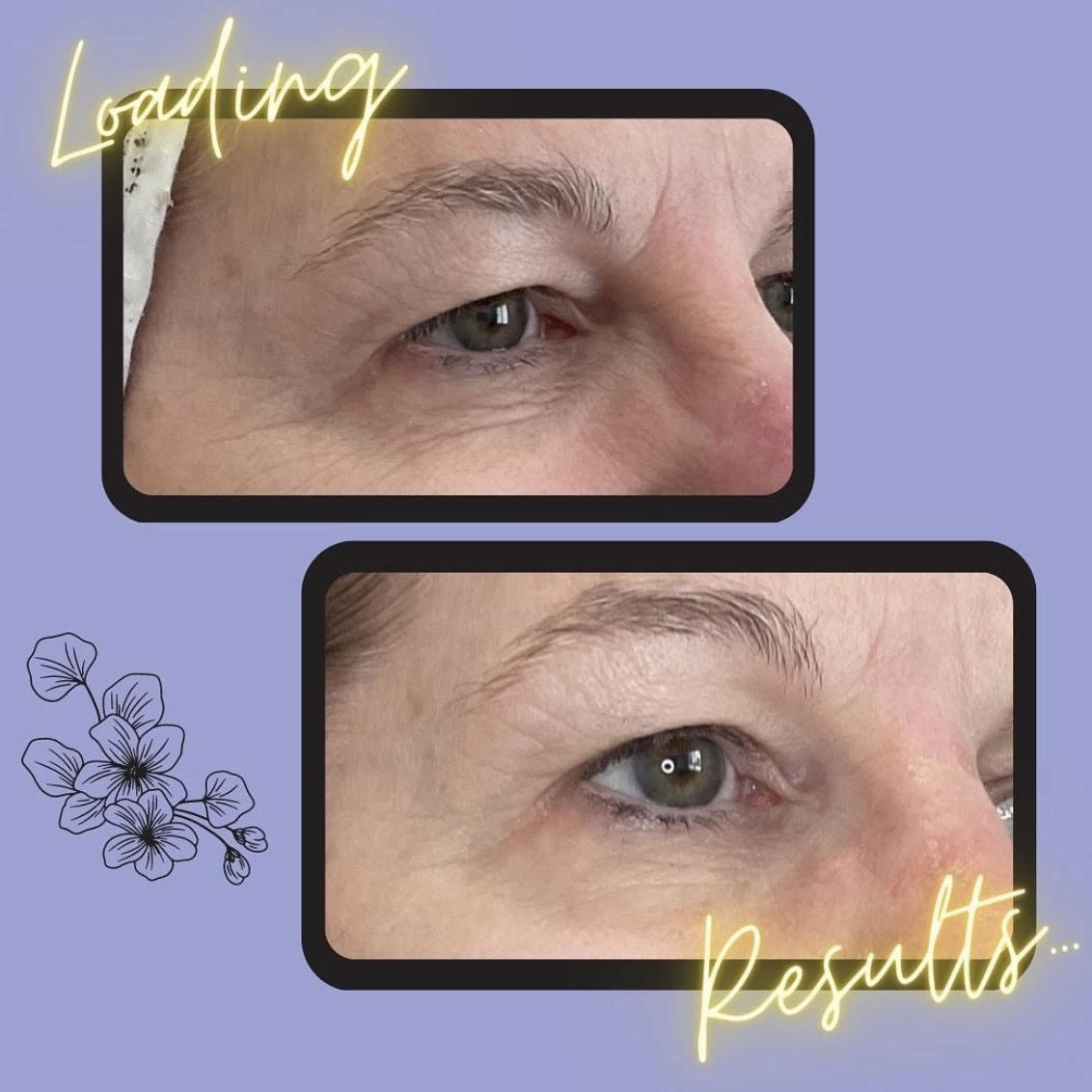 11s before and after botox