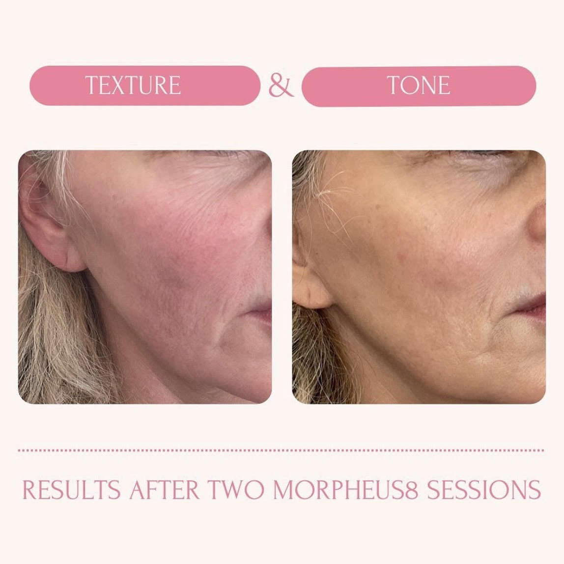 11s before and after botox