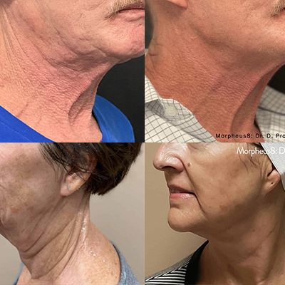 Botox before and after