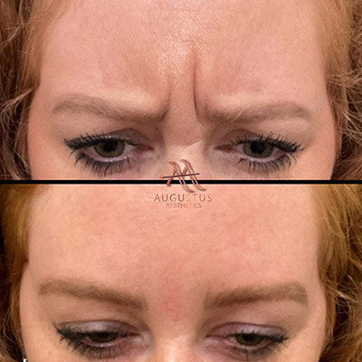 11s before and after botox