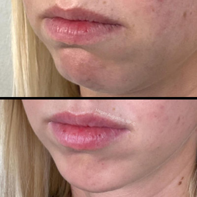 chin botox before and after