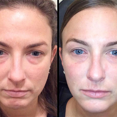 cheek augmentation before and after filler