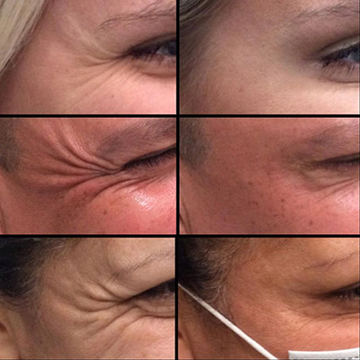 crows feet before and after botox