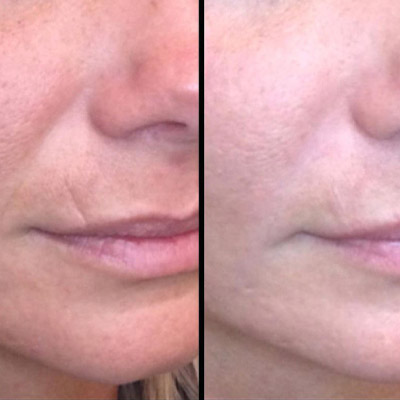 fine lines and smile lines before and after
