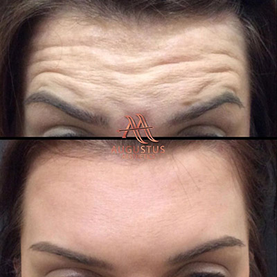 forehead wrinkles before and after botox