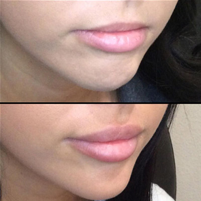 Lip filler before and after