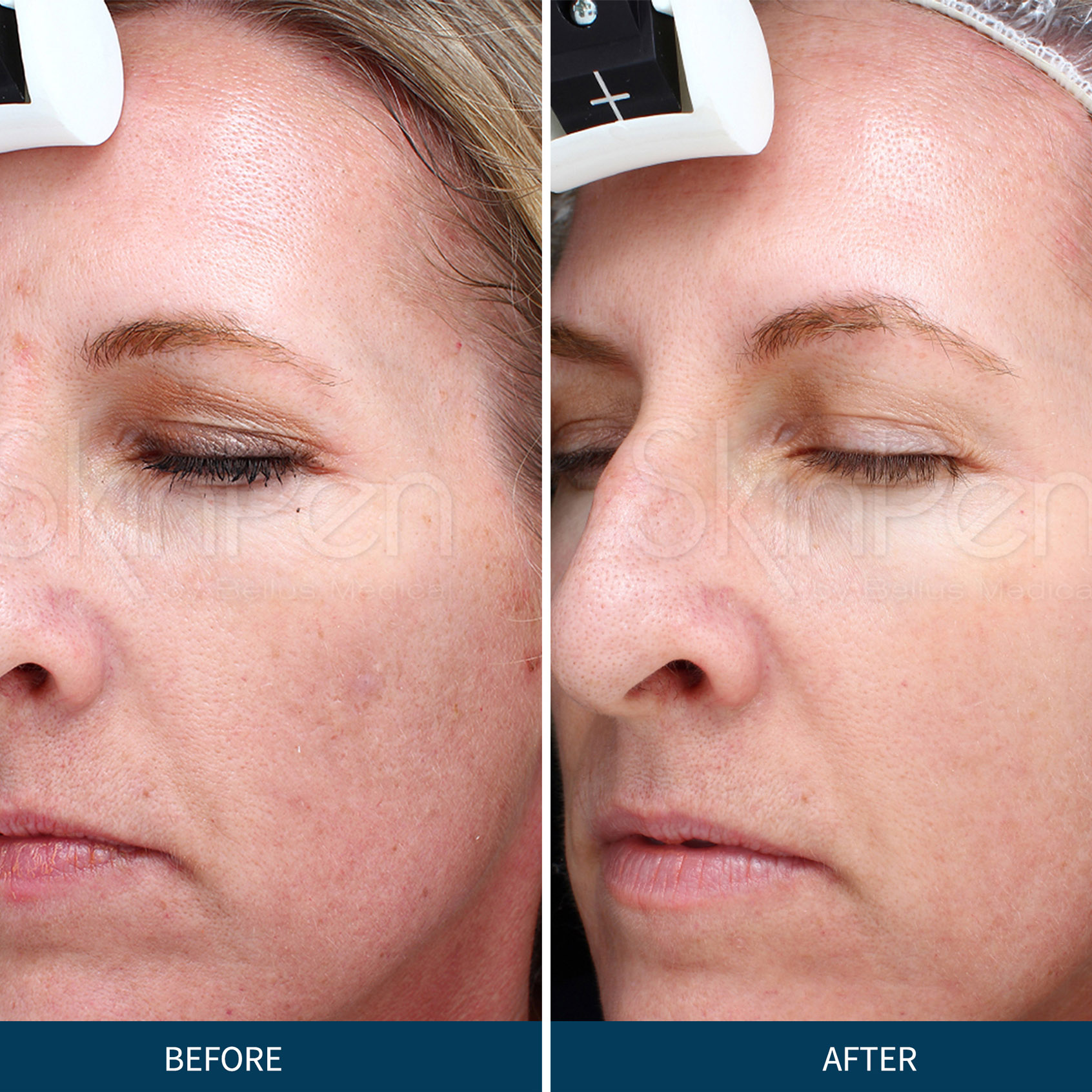 skinpen microneedling before and after