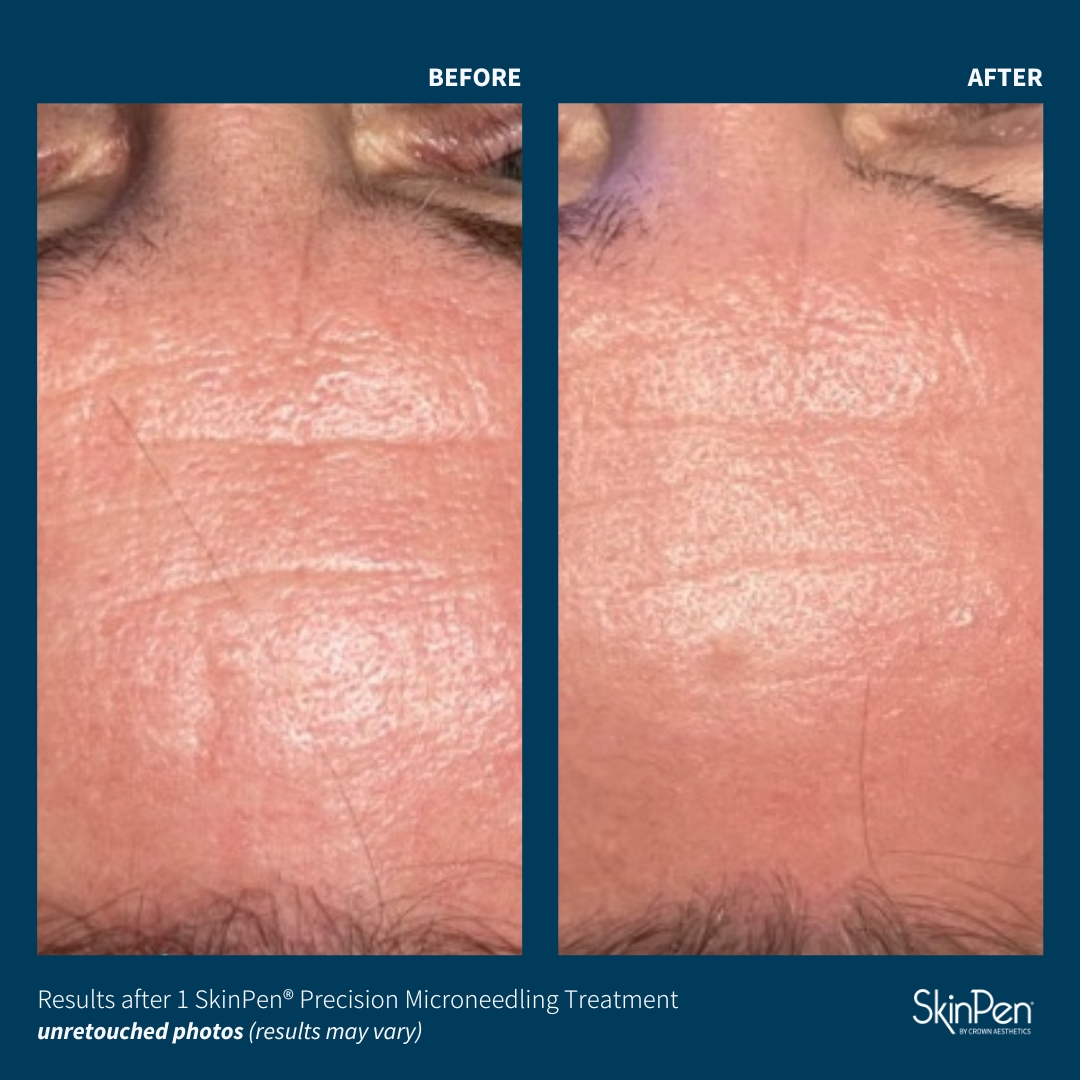 skinpen microneedling before and after