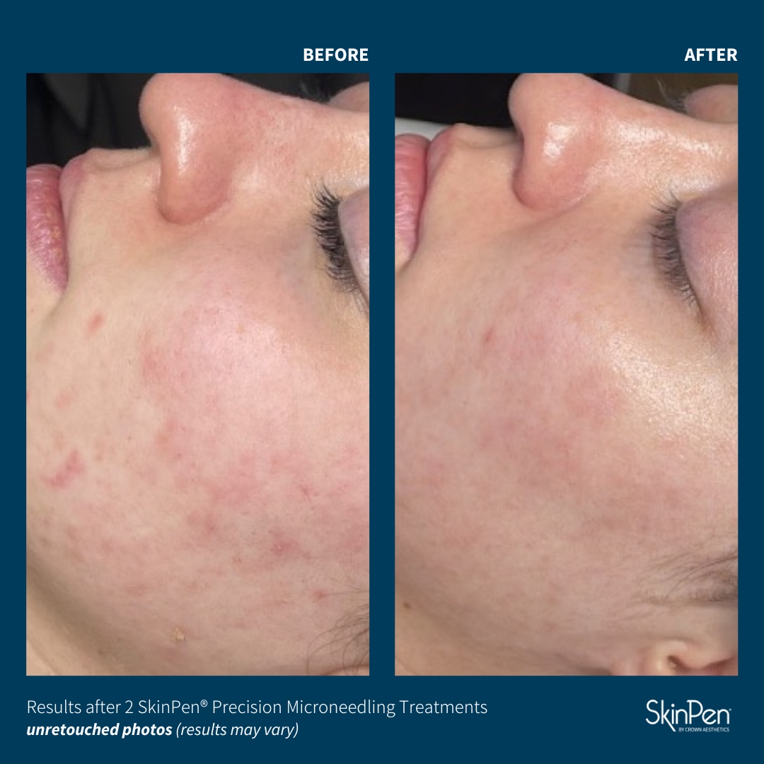skinpen microneedling before and after